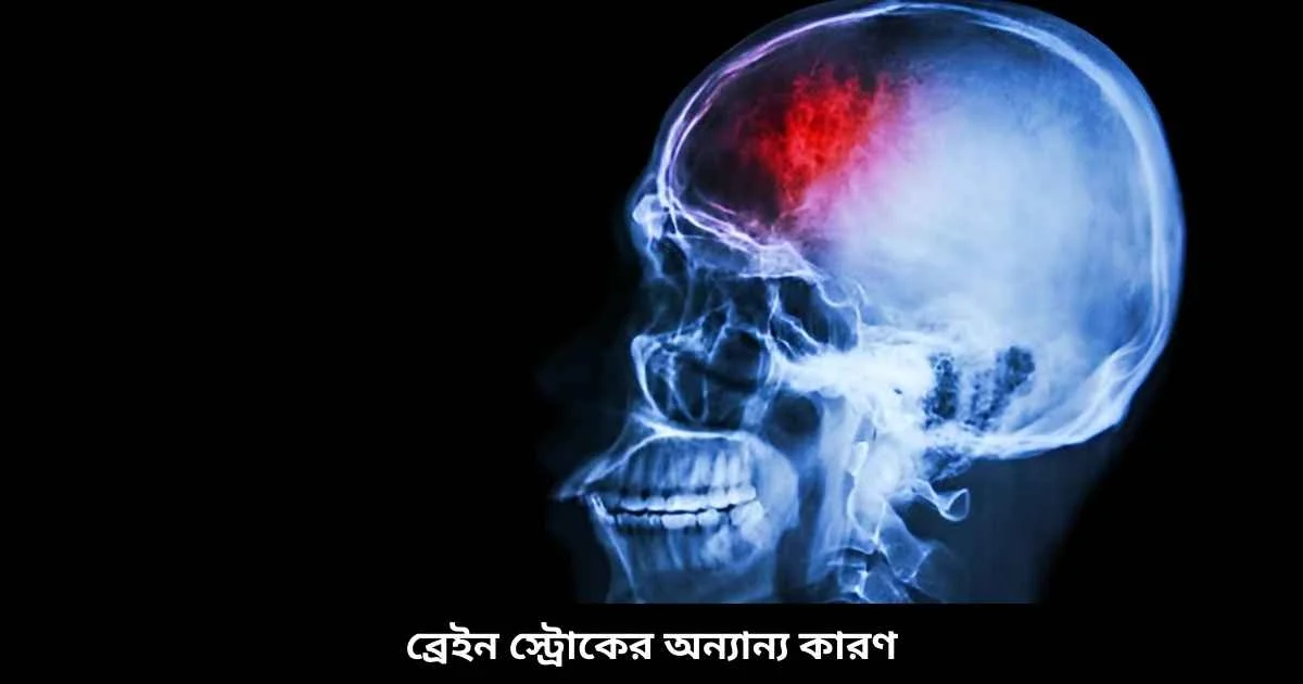 ব্রেইন স্ট্রোকের অন্যান্য কারণ