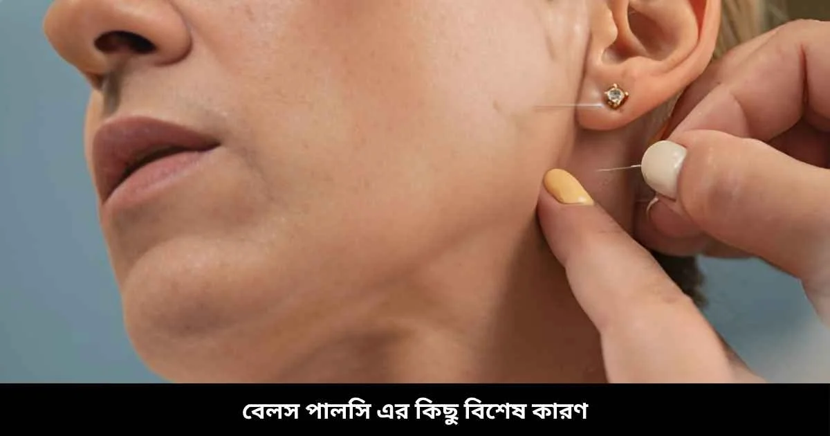 বেলস পালসি এর কিছু বিশেষ কারণ