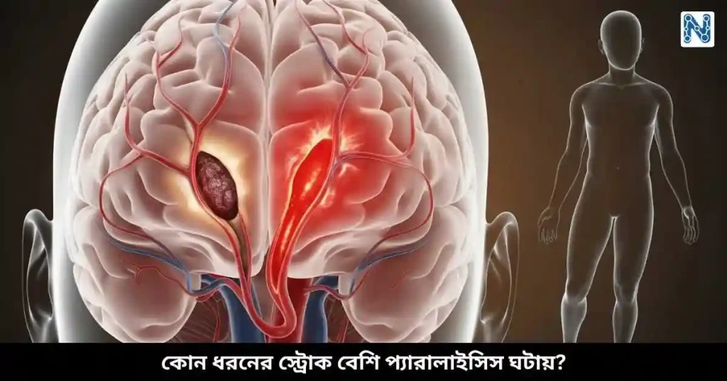 কোন ধরনের স্ট্রোক বেশি প্যারালাইসিস ঘটায়