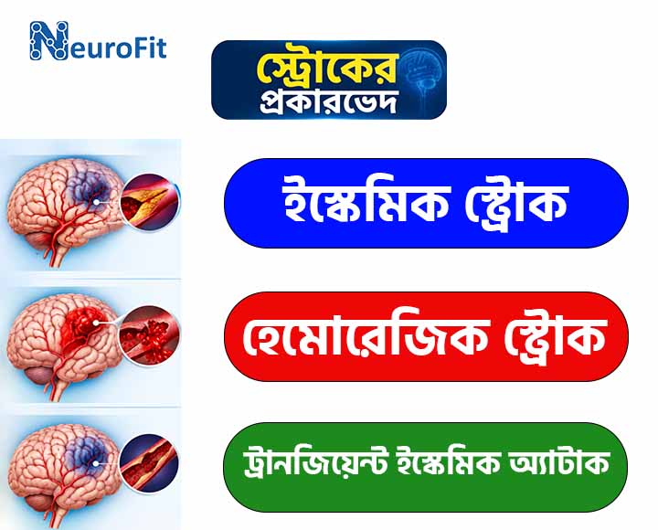 কি কি কারণে স্ট্রোক হয়: জানুন মস্তিষ্কে রক্ত সঞ্চালনের ব্যাঘাতের প্রধান কারণ, ঝুঁকি ও প্রতিরোধের উপায় 3 স্ট্রোকের প্রকারভেদ